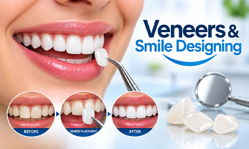 Veneers and smile designing