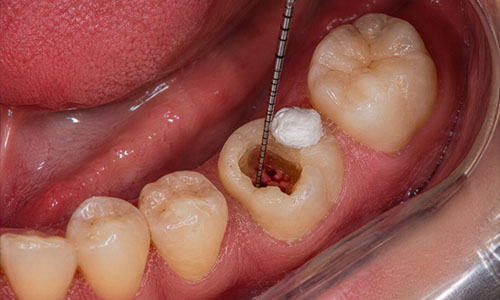 Root canal treatment