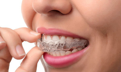 Clear aligner therapy