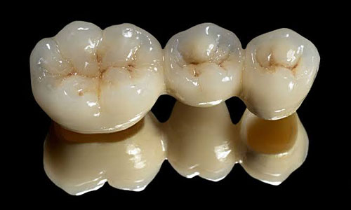 Crowns and bridges