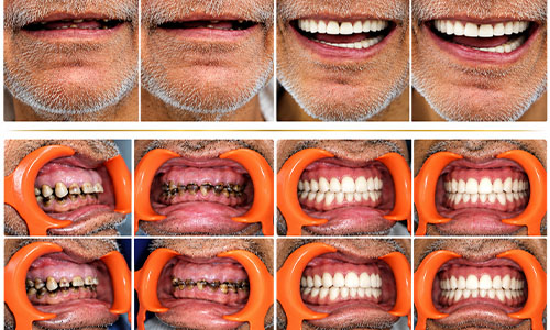 Full mouth rehabilitation
